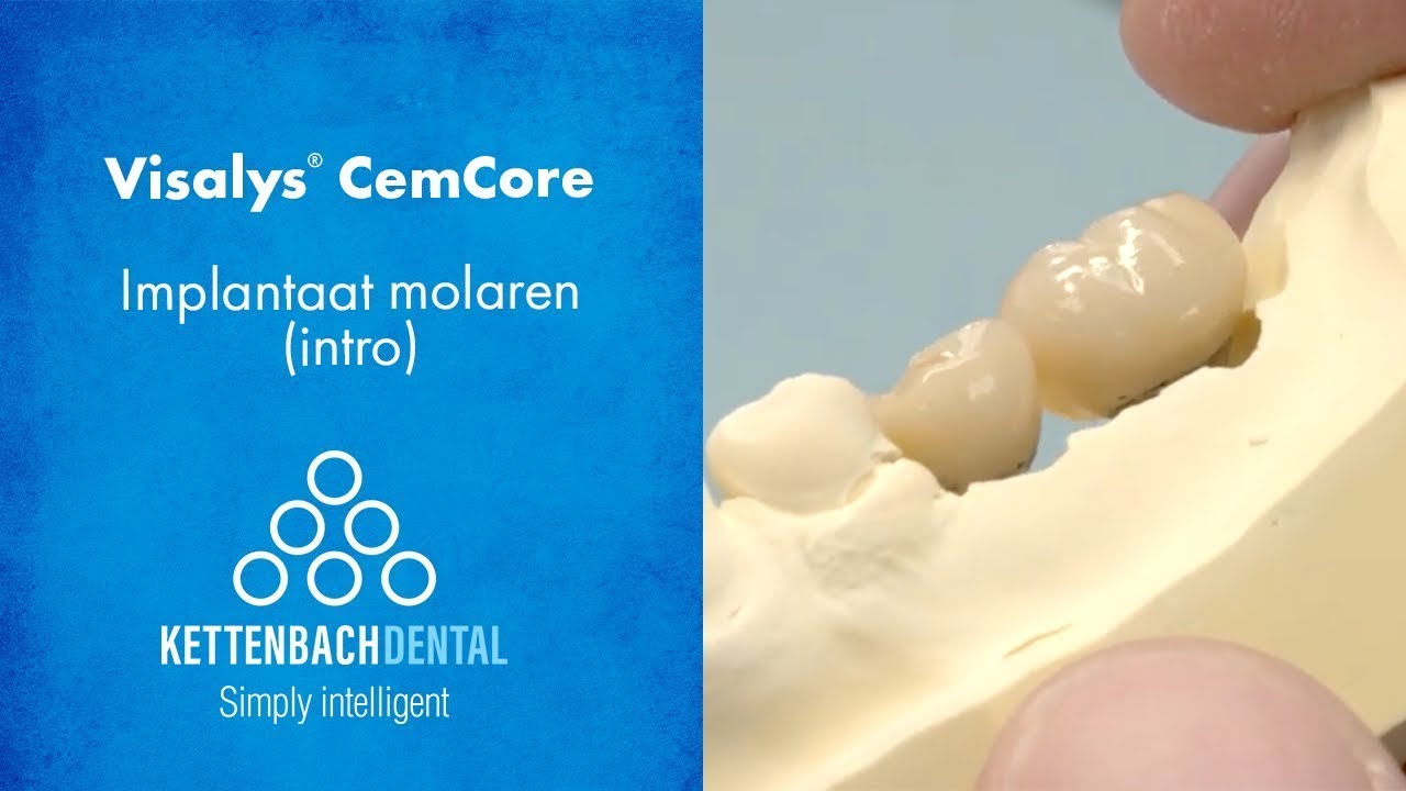 Visalys® CemCore cementeren kronen op abutments
